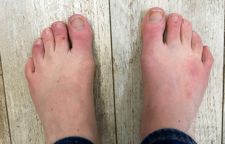 Chilblains toes. Do you get chilblains each winter? Well, I do. At the first sight of snow, angry, itchy, red welts appear on my feet and slowly creep up my toes. I immediately start panicking about how to stop chilblains itching. 